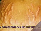 stretch marks men treatment - stretch marks how to prevent -