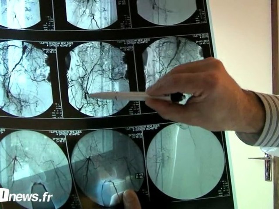 Dépistage de l'artérite à Pontoise