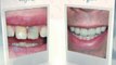Cosmetic Dentist Toronto CA Dentist Canada Smile Makeovers