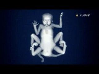 Lakshmi: La niña con 8 extremidades (2) (Gemelo parasito)