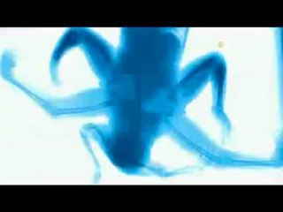 Lakshmi: La niña con 8 extremidades (1) (Gemelo parasito)