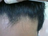 Hair Transplant Clinic Lahore result after 1 year