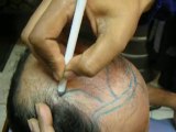 Baldness-Hair Loss-Hair restoration Clinic Pakistan Part 2