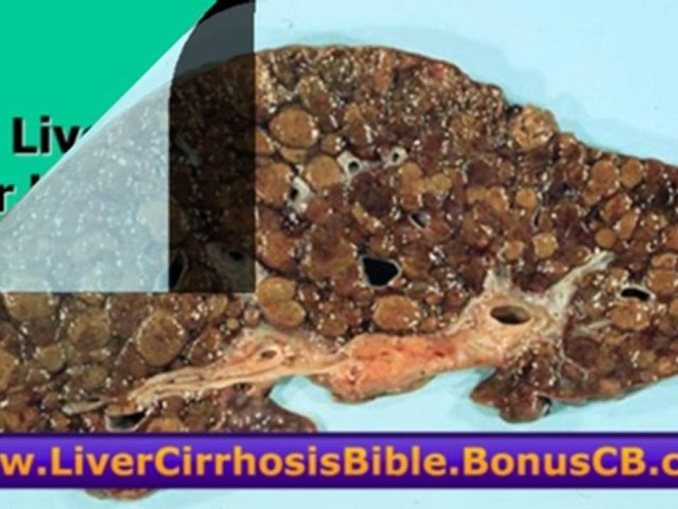 Cirrhosis Liver Cure - Cirrhosis Liver Treatment