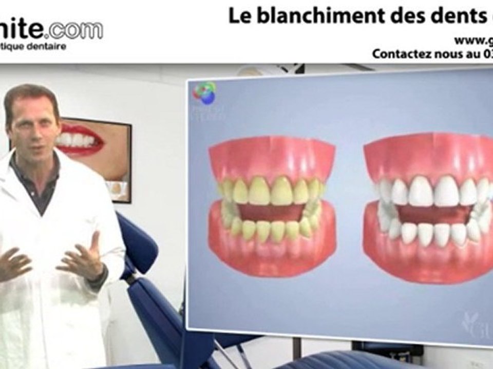 Blanchiment des dents, avoir les dents blanches