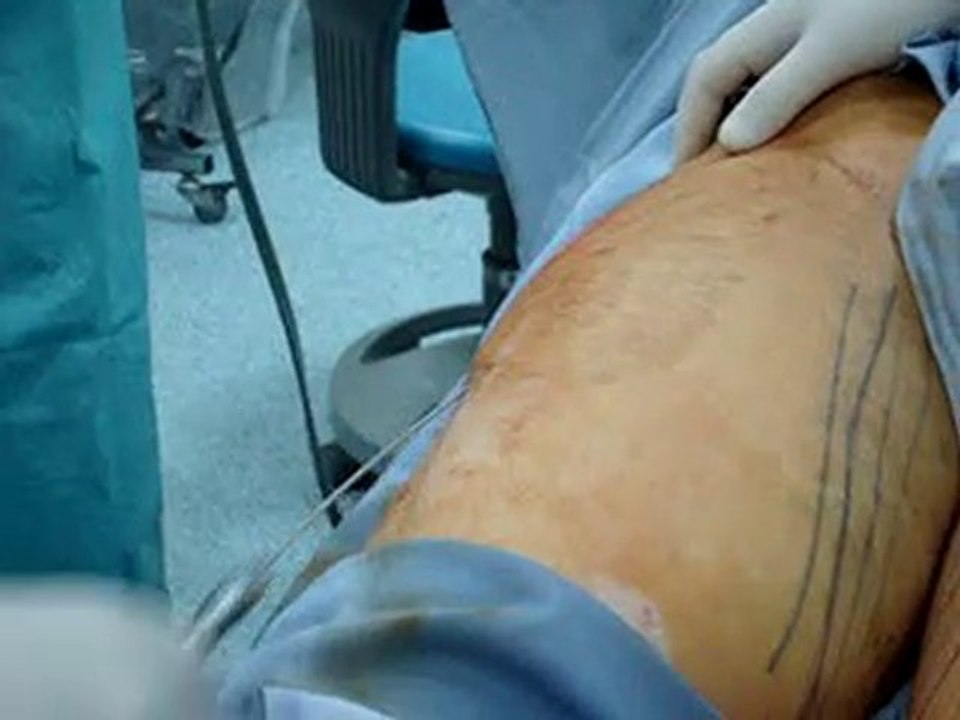 LIPOSUCTION BY LASERشفط الدهون