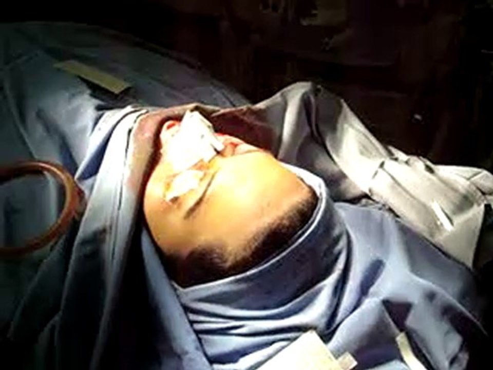 rhinoplasty-تجميل الانف