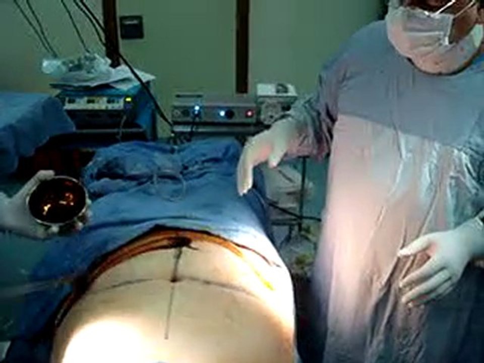 tummy tuck-تجميل البطن