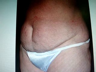 tummy tuck-تجميل البطن