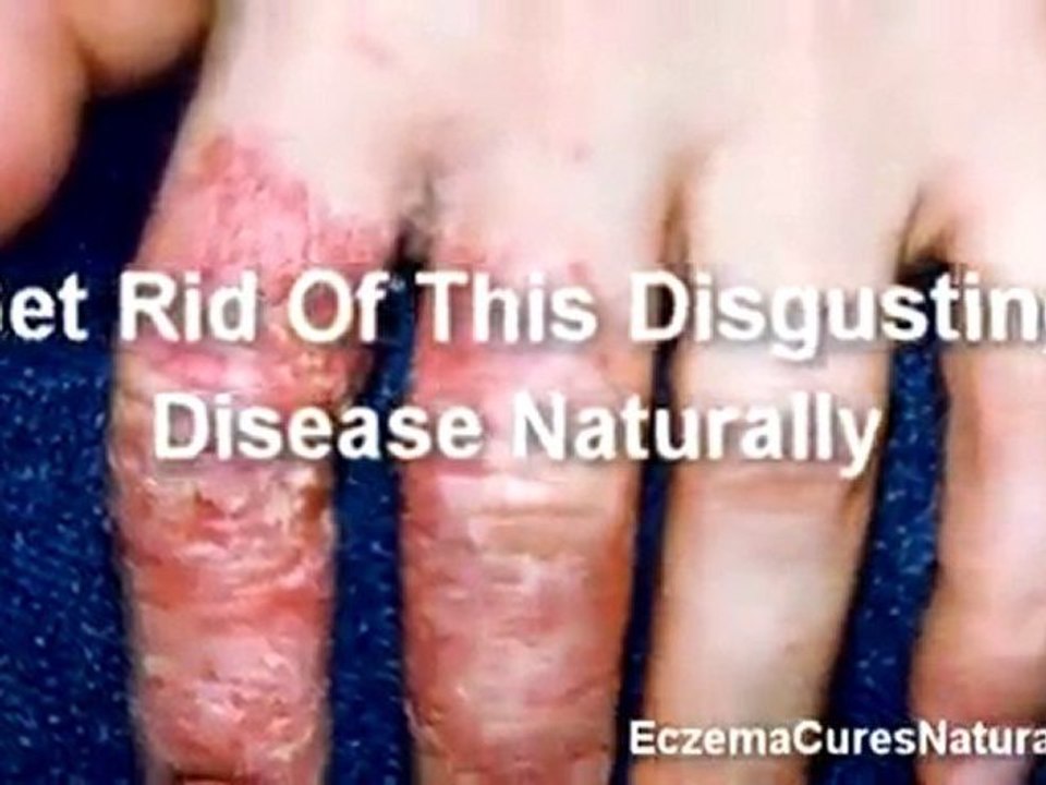 Eczema Cures Natural | Natural Eczema Cures | Eczema Cures