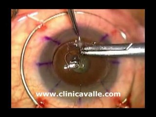 Trasplante de córnea