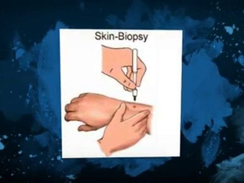 Understanding Eczema Rashes and Eczema creams