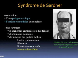 Quand une tumeur peut en cacher une autre