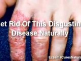 Learn The Eczema Cures Natural Way | Natural Eczema Cures |