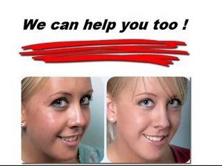 Get rid of acne and blackheads