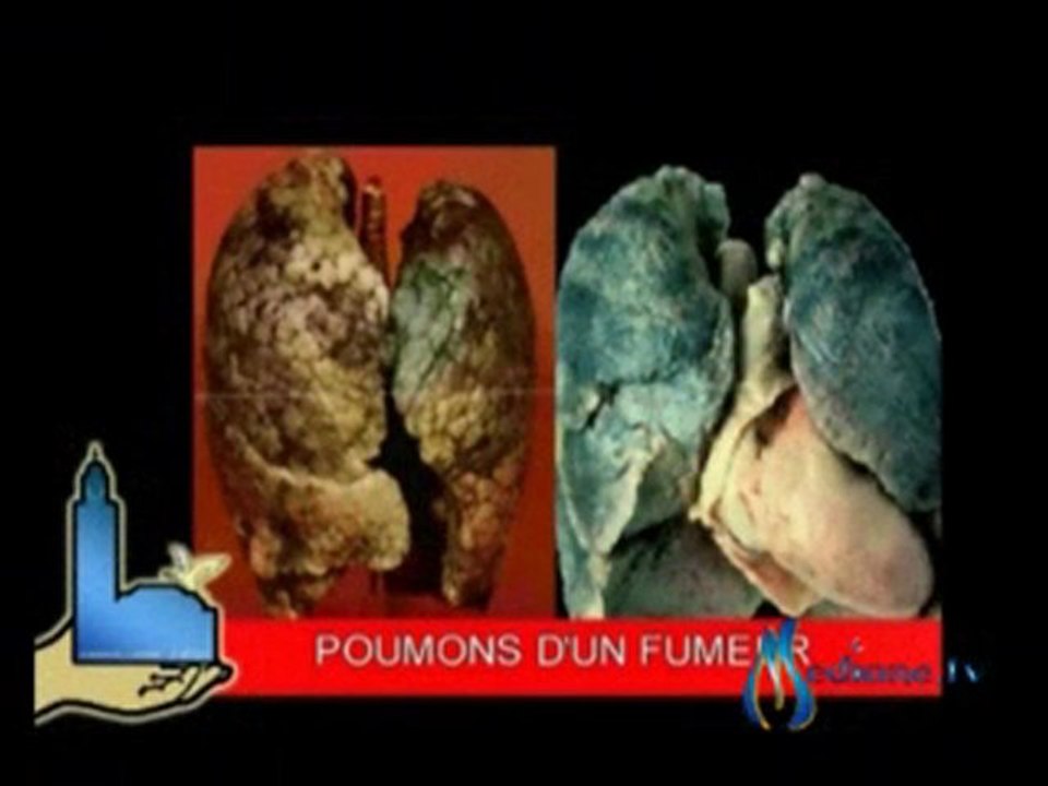Les dangers du Tabac - Mustafa Bouhoute (Part.3)