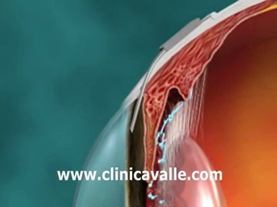Valvula para Glaucoma