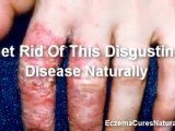 Learn The Eczema Natural Cures | Natural Eczema Cures | Ecz