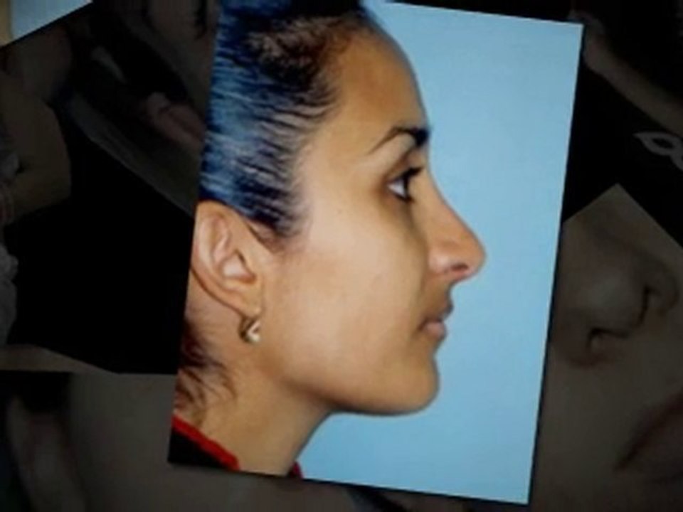 Facial Cosmetic Surgery - Getting Ready For That ...