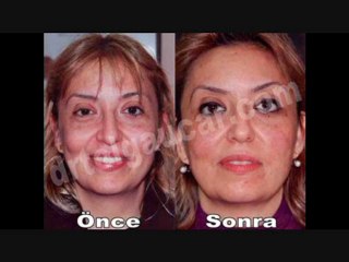 Akupunktur ile Yüz Estetiği