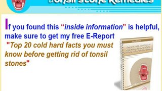 What is the best way to get rid of tonsil stones?