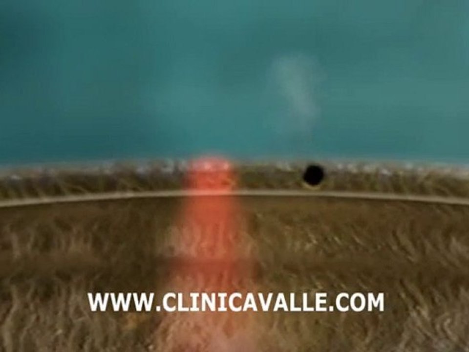 Trabeculoplastía