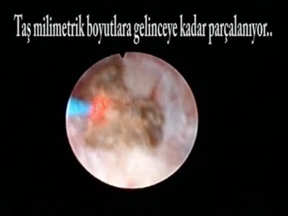 KEAH Üroloji Kliniği Retrograd İntra-Renal Cerrahi