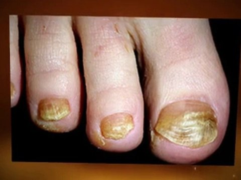 Toenails Fungus - Get Rid Of Toenails Fungus