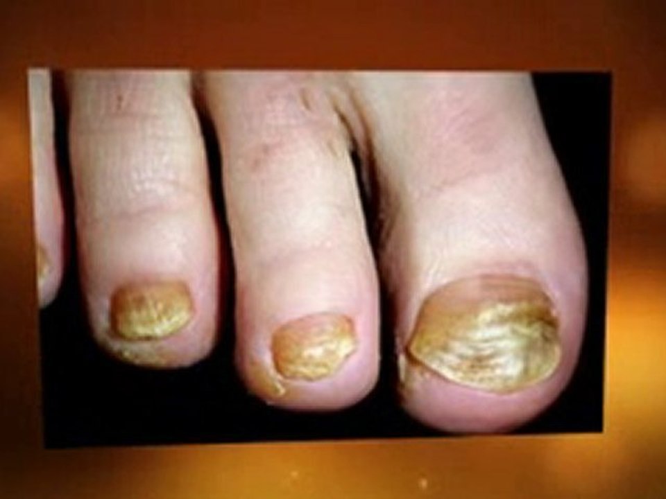 Toenail Fungus Remedies - Toenail Fungus Remedies That Work