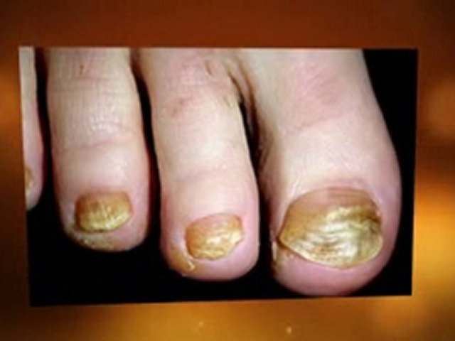 Toenail Fungus Remedies - Toenail Fungus Remedies That Work