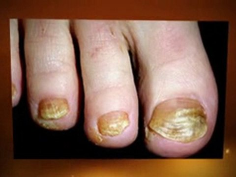 Toenails Fungus - Get Rid Of Toenails Fungus
