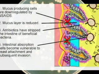 Candida Albicans Intestinal