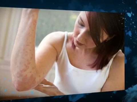 Eczema cures Natural| Eczema Cure| Eczema Treatment| Eczema