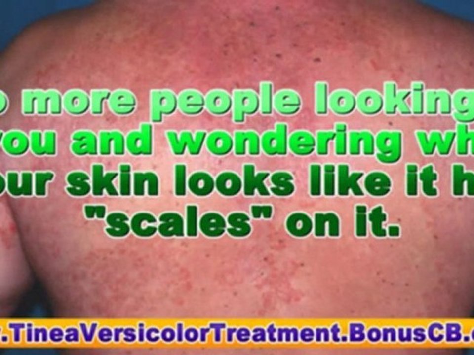 treating tinea versicolor - tinea versicolor treatments - sk