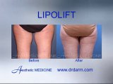 Before and After - Lipolift inner and outer thighs