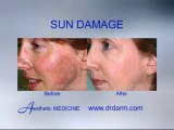 Before and After - Skin Problems Sun Damage