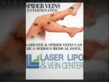 Vein Care Treatment at vein treatment center