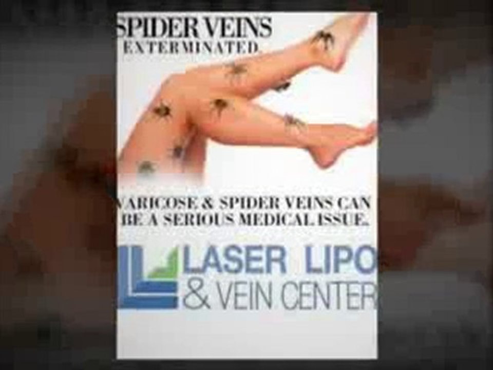 Vein Care Treatment at vein treatment center