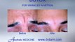 Before and After - Wrinkles Botox for wrinkles in motion