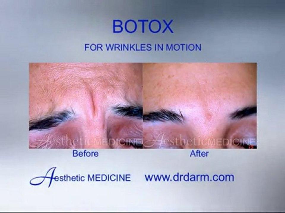 Before and After - Wrinkles Botox for wrinkles in motion
