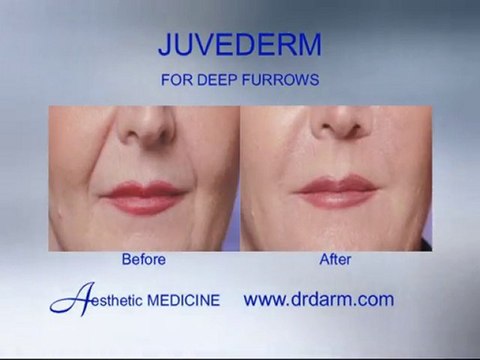 Before and After - Wrinkles Juvederm for deep furrows