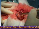 Kidney Disease Diet Renal Failure Diet - Kidney Diet Secrets