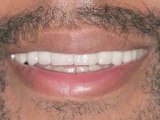 Cosmetic Dentistry: Porcelain Veneers : Why would I want dental veneers?