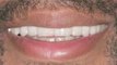 Cosmetic Dentistry: Porcelain Veneers : Why would I want dental veneers?