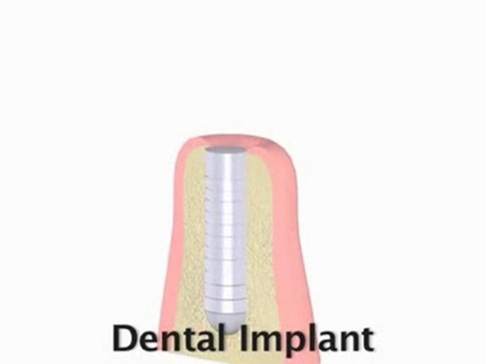 Oral Surgery, Dental Implants : What are "denta...