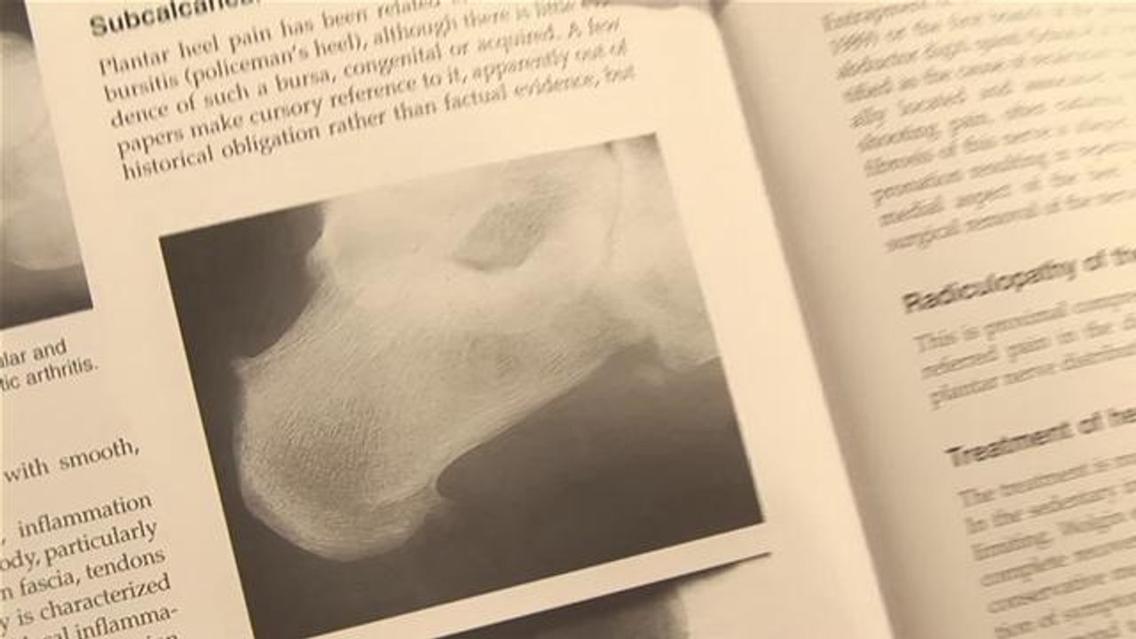 How To Get Rid Of A Bone Spur In Your Heel
