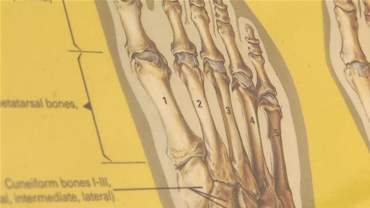 How To Cure With Metatarsalgia