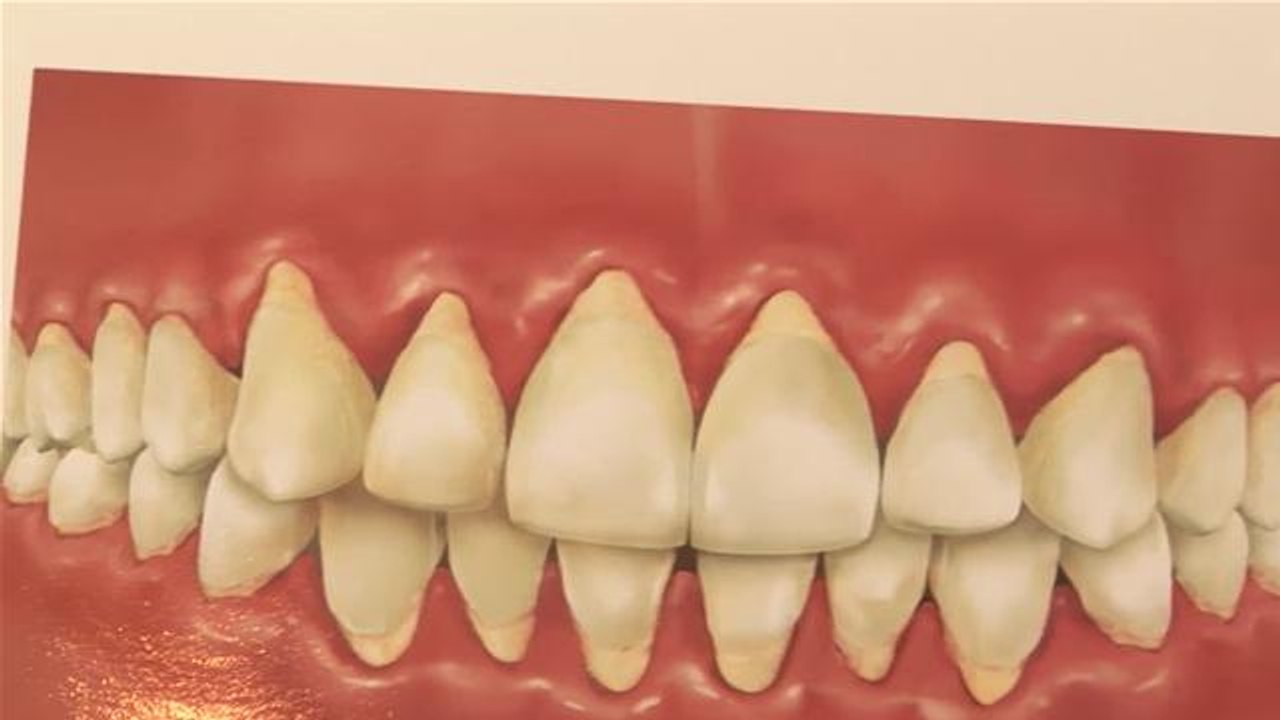 How To Treat Receding Gums