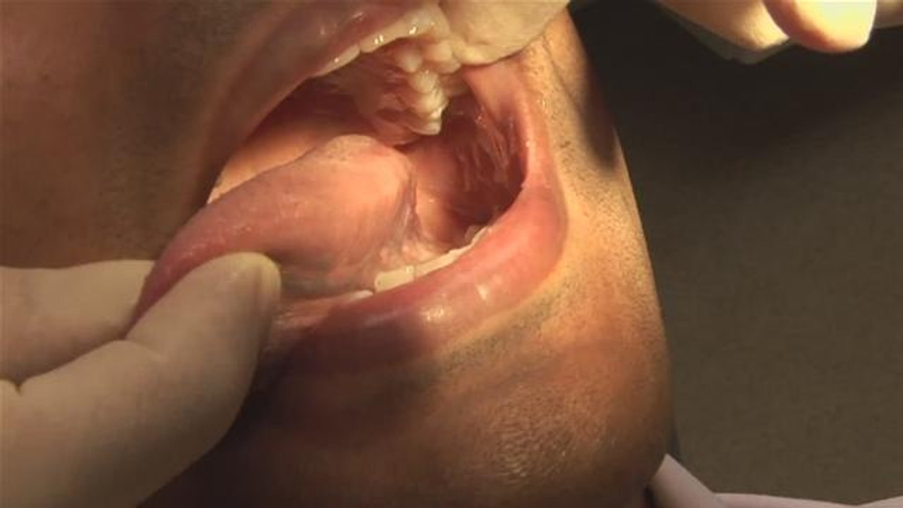 How To Inspect The Mouth For Cancer