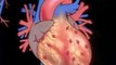 Serious Heart Conditions Explained : What is a 